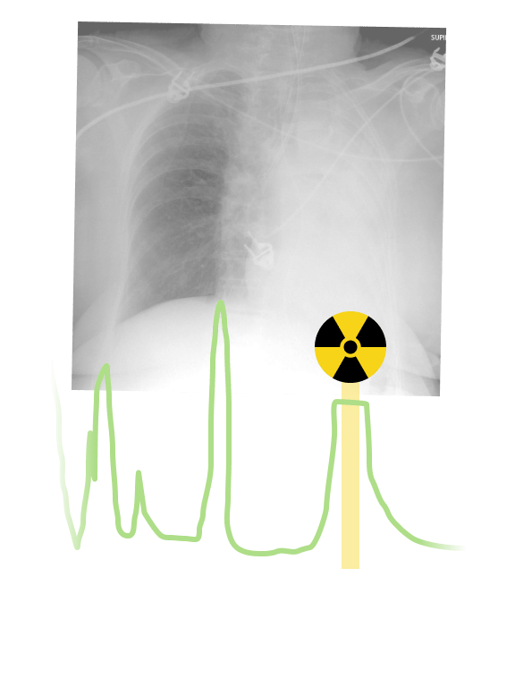 X-ray Ventilator Synchronization Screenshot